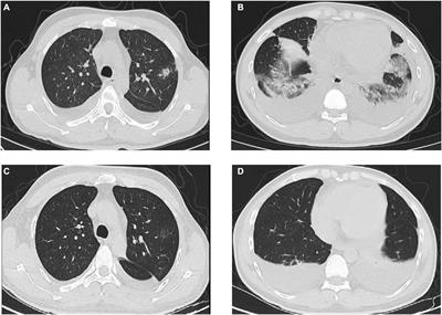 A case report: Comorbidity of Rhinocerebral mucormycosis and pulmonary aspergillosis with challenging diagnosis